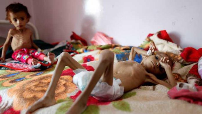 الحرب اصابت 46% من اطفال اليمن بالتقزم ما سيعيق نموهم العقلي والبدني وإنتاجيتهم مدى الحياة