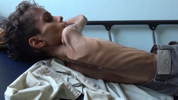 الجوع الشديد في اليمن