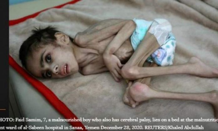 وكالة رويترز: اليمني(فايد).. قصة بلد يعاني من الحصار والجوع