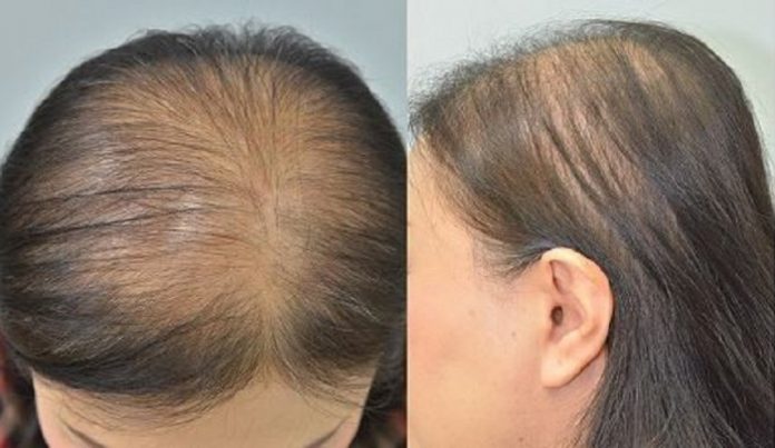 علاج التساقط.. علماء يكشفون عمّا يساعد في زيادة نمو الشعر