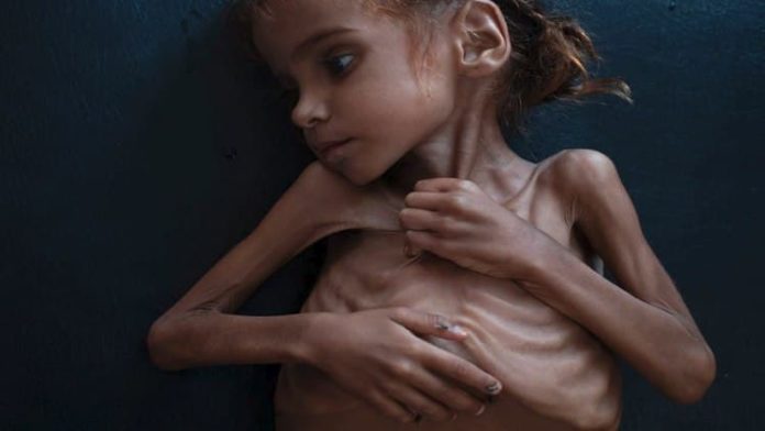 برنامج الأغذية العالمي: حرب السعودية وحصارها يدفعان اليمنيين الى أكل أوراق الشجر